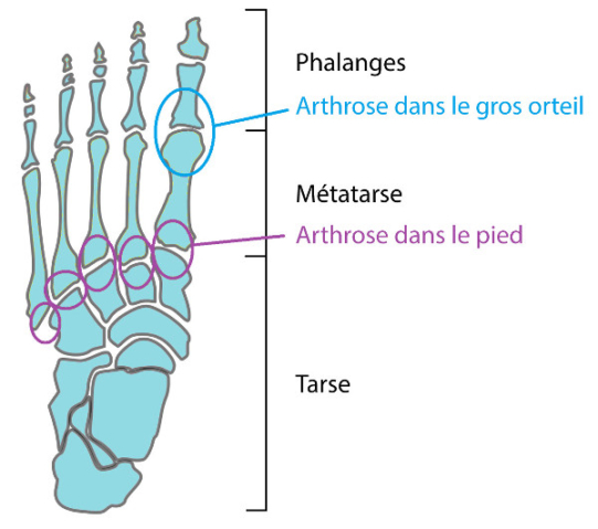 Zones liées à l'arthrose du pied